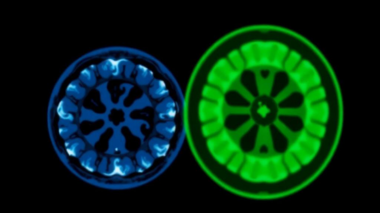 AI Model Sharpens Low-Dose CT Scans While Cutting Radiation Exposure
