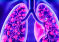 Antibody-Drug Conjugate Shows Striking First-Line Results in HER2-Driven Lung Cancer