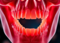 Oral Cancer Cells Hijack Jaw-Destroying Cells Through an Inflammatory Relay, Study Finds