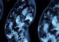 AI Reads Routine Mammograms to Predict Breast Cancer HER2 Status Without Biopsy
