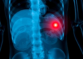 AI Sees What Isn't There: Chest X-Rays Don't Reveal Groin Hernias, Study Warns
