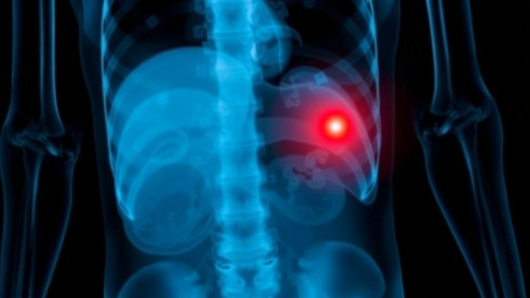 AI Sees What Isn't There: Chest X-Rays Don't Reveal Groin Hernias, Study Warns