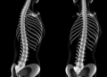 Fake spines, real gains: synthetic CT data teach AI to segment severe scoliosis