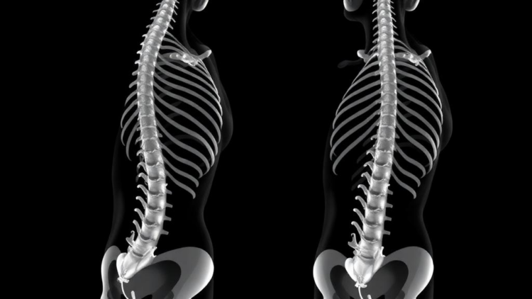 Fake spines, real gains: synthetic CT data teach AI to segment severe scoliosis