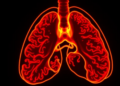 Focused radiosurgery doubles survival in lung cancer that spreads to the brain