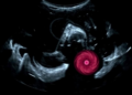 AI Learns to Fake Ultrasound Images to Spot Breast Tumors More Accurately