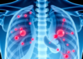 Simple Ratio of Cancerous Lymph Nodes Predicts Bladder Cancer Survival, Massive Analysis Finds