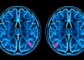 Random-Walk MRI Links Brain Tumour Scans to Microscopic Reality