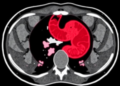 AI Reads CT Scans to Predict Hidden Gastric Cancer Risks Before Surgery