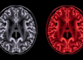 Brain Scan Study Reveals How Gluten Can Attack the Cerebellum in Two Very Different Ways