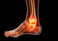 AI Shows Promise Against Diabetic Foot Bone Infections, But Key Gaps Remain