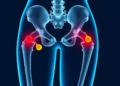 Massive 20-Year Study Maps How 99 Foods and Nutrients Shape Hip Fracture Risk in Older Women