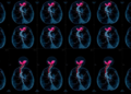 AI Reads Whole Coronary Angiograms and Predicts Heart Risk a Year Ahead