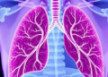 A 'Textbook' Recovery After Lung Cancer Surgery Predicts Who Lives Longer