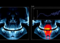 AI Reads Dental X-Rays and Patient Data Together to Gauge Gum Disease Severity