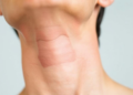 Skin Darkening on the Neck May Reveal Hidden Insulin Overload Before Blood Sugar Rises