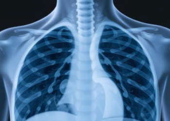 Four Simple Measures May Predict Who Survives Bacterial Pneumonia