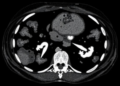 Spectral CT Muscle and Tissue Measures Predict Survival After Junctional Cancer Surgery
