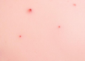 Skin Disease, Silent Metabolism: Large Database Study Links Hidradenitis Suppurativa to Type 2 Diabetes
