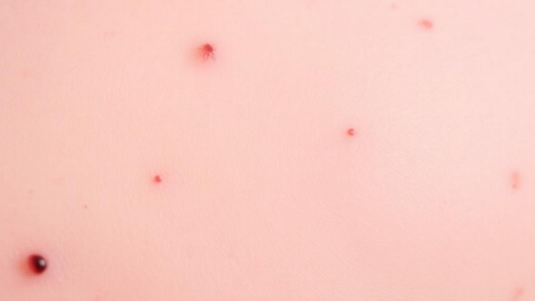 Skin Disease, Silent Metabolism: Large Database Study Links Hidradenitis Suppurativa to Type 2 Diabetes