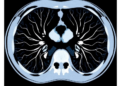Chest CT Scans Get Sharper and Cleaner as Iterative Reconstruction Levels Rise