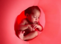 In Womb Inflammation May Weaken the Skin Barrier of the Earliest Born Babies