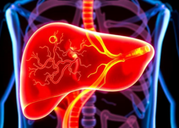Low Vitamin D Tracks With Liver Scarring in Fatty Liver Disease, But Causality Remains Unclear