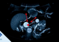 Hidden Liver Lesions Reveal Their Secrets to Contrast Ultrasound in Landmark Study