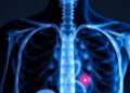 No Single Test Can Reliably Diagnose Respiratory Sarcopenia, Landmark Review Finds