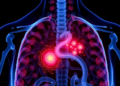 AI Reads the Tumor and Its Surroundings to Predict Surgery Risks in Thymoma Patients
