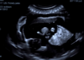 Vision Transformers Team Up With CNNs to Sharpen Blurry Ultrasound Images