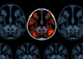 AI Reads Breast MRI Scans to Predict Cancer Recurrence Risk Before Surgery