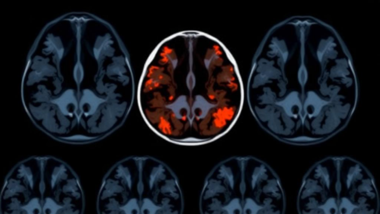 AI Reads Breast MRI Scans to Predict Cancer Recurrence Risk Before Surgery