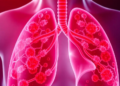 Regulatory Immune Cells Rise With Lung Cancer Severity, Blood Study Finds