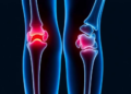 Diabetes Complication Strikes Three Joints in Seven Years in Rare Case Report