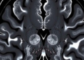 Sharper MRI Zoom Technique Reveals Tumor Edges but Shifts Key Cancer Numbers