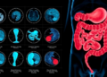 AI Model Fuses Scans, Blood Tests and Endoscopy Images to Gauge Crohn's Disease Activity