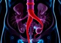 New Survival Calculator Predicts Outcomes in Rare Early-Onset Urinary Tract Cancer