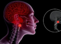 When the Sentinel Node Vanishes: Hidden Warning Sign in Head and Neck Melanoma