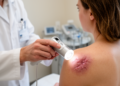 A Simple Skin Camera Test May Predict Which Keloids Respond to Steroid Injections