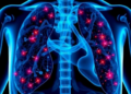 Scientists Uncover a 45-Gene Signature That Predicts Prostate Cancer Spread
