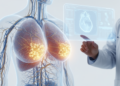 AI Model Predicts Breast Cancer Spread to Lymph Nodes Before Surgery
