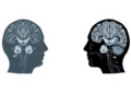 Blood Protein Tracks Early Multiple Sclerosis Damage, But MRI Still Holds the Prognostic Edge