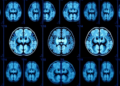 AI Reads Brain Scan Sequences to Spot Alzheimer's With New Hybrid Model