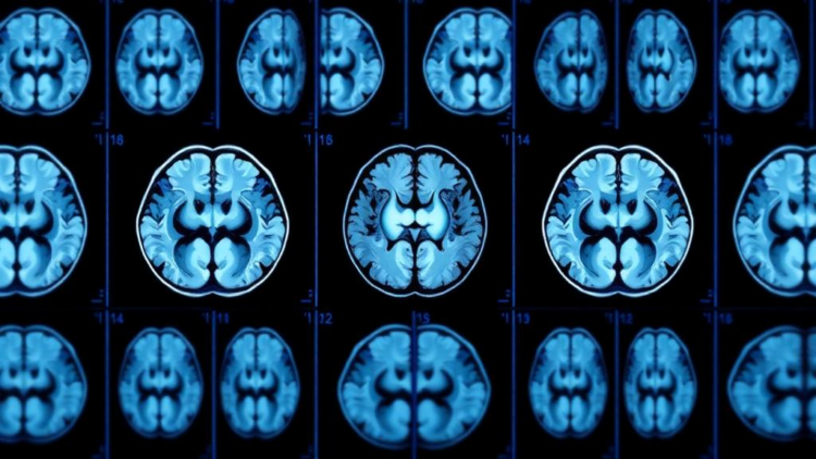 AI Reads Brain Scan Sequences to Spot Alzheimer's With New Hybrid Model
