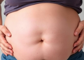 Hernia Repair in Severe Obesity Shows Low Short-Term Risk but Higher-Than-Expected Recurrence