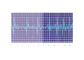 New EEG Algorithm Predicts Anesthesia Sensitivity in First 10 Minutes