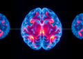 AI Combines Brain Scans and Clinical Data to Predict Stroke Recovery Outcomes
