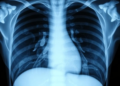 AI Turns Chest X-rays into Draft Radiology Reports with a Two-Stage Keyword Pipeline