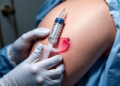 Inflating the Donor Site: Simple Fluid Injection Helps Skin Grafts Take Hold and Heals Wounds Faster